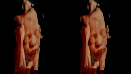 Tehnologia 5D revoluţionează ecografia: Poţi vedea cu claritate fiecare trăsătură a bebeluşului tău înainte de a-l naşte! (VEZI FOTO)