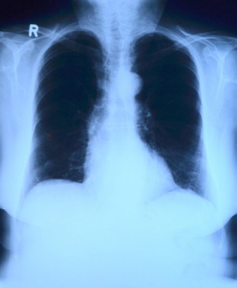 ALARMANT! Zeci de cazuri de cancer pulmonar depistate la Arad în nici trei luni