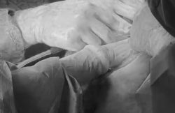 Bărbat salvat de medicii arădeni, după o intervenție chirurgicală contracronometru item-thumbnail