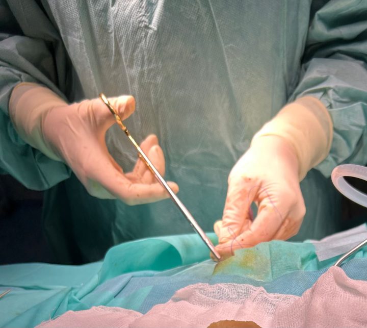 Intervenție salvatoare pentru o tânără mamă. Medicii arădeni i-au extirpat o tumoră cerebrală agresivă de mari dimensiuni item-thumbnail